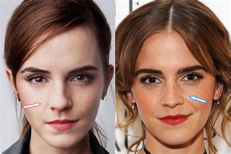 Emma Watson Cosmetic Surgery - Nose Job, Teeth & Breast Implants?