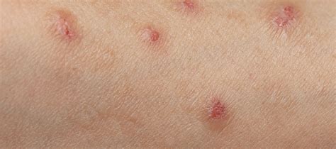 Skin Lesions Meaning Types Of Skin Lesions Treatment - vrogue.co