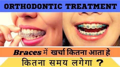 Teeth Clip Treatment In Hindi || Teeth Braces Treatment || Student Doubts || - YouTube