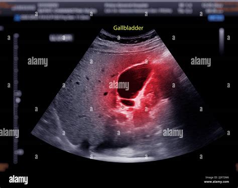 Ultrasound upper abdomen showing gallbladder for diagnosis gallbladder ...