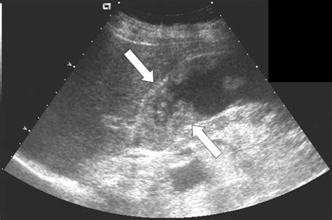 Gallbladder Ultrasound Cancer