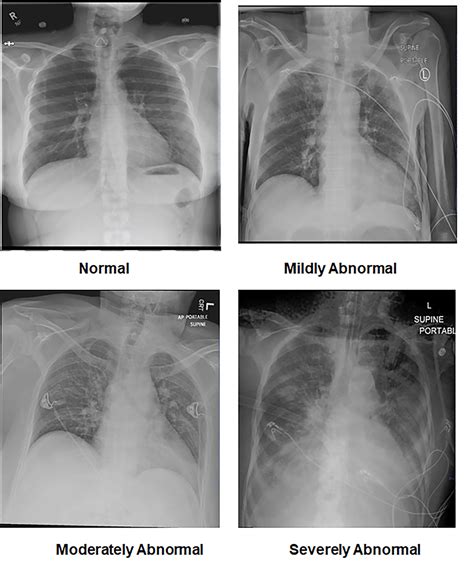 Cureus Bilateral Hemopneumothorax In Covid 19 - vrogue.co