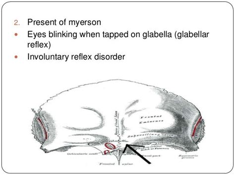 Parkinson s disease