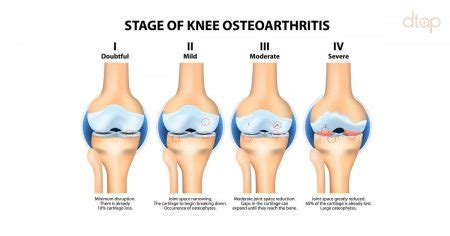 knee osteoarthritis Archives | Men's Health Singapore