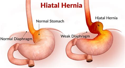 Hiatal Hernia - Causes, Symptoms, Diagnosis, Treatment and Surgery