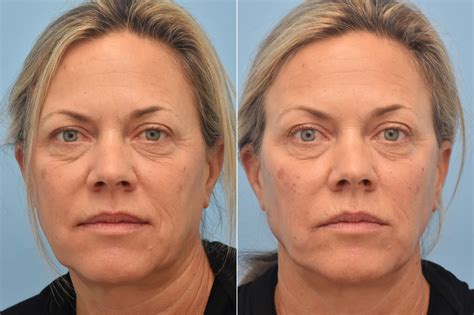 Injectable Fillers photos | Philadelphia, PA | Patient 1325