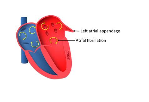 Left Atrial Appendage Occlusion - The Birmingham Heart Rhythm Group