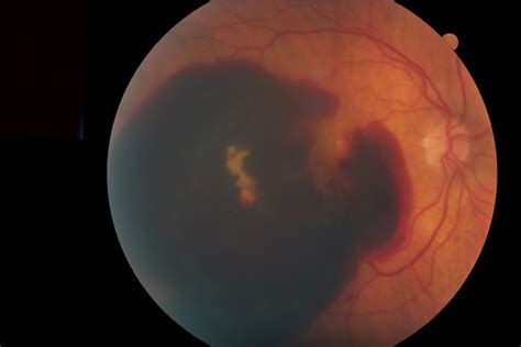 Macular Degeneration - The Retina Centers of Washington