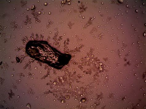 Prurigo nodularis: Understanding the symptoms