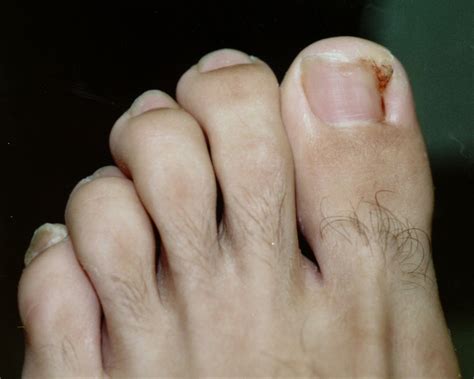 Pictures of Ingrown Toenails ~ Ingrown Toenail