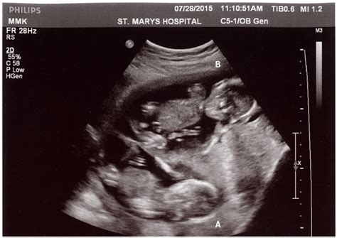 Did You Find Out It Was Twins At Later Ultrasound? Twin Ultrasound? - Twiniversity