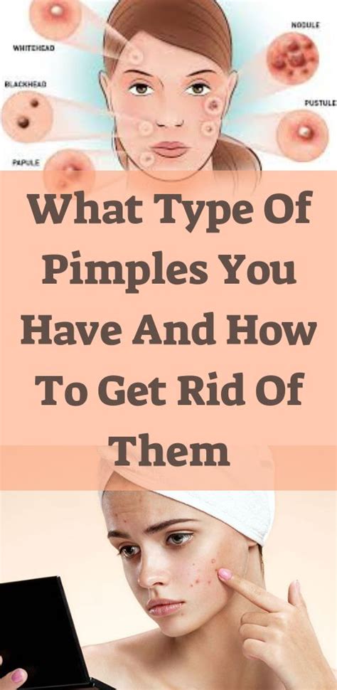 What type of pimples you have and how to get rid of them | Pimples on face