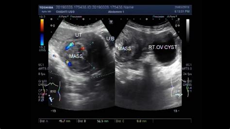 Ovarian Cyst On X Ray