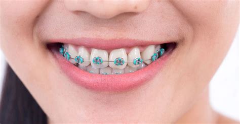 What Should You Do If A Bracket Or Wire Breaks On Your Braces? - Weston Dental Office