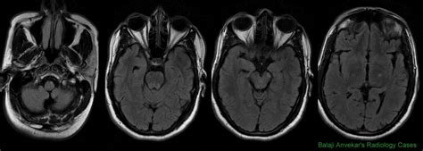 Dr Balaji Anvekar's Neuroradiology Cases: Wallerian degeneration MRI Brain