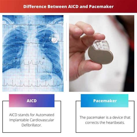 AICD vs Máy tạo nhịp tim: Sự khác biệt và So sánh