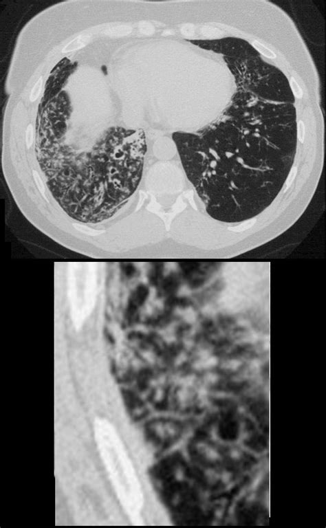 Faces of Centrilobular Nodules | Lungs