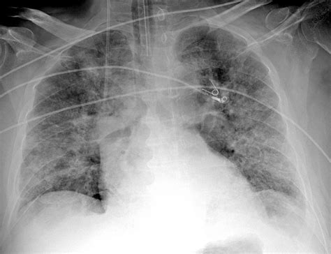 Pneumonia Chest X Ray : Aspiration pneumonia - Radiology at St. Vincent's ... - A basic ...