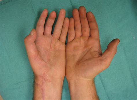 Hand Reconstruction Surgery | Hand Surgery Associates