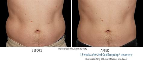 CoolSculpting Elite Before and After | New Treatment and Better Results