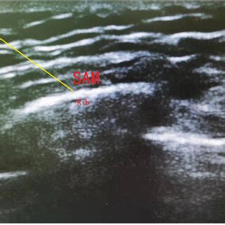 Ultrasound image showing the serratus anterior plane block. Yellow line ...