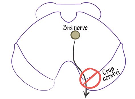 Neuroanatomy Glossary: Midbrain Stroke: Weber’s Syndrome | ditki medical & biological sciences