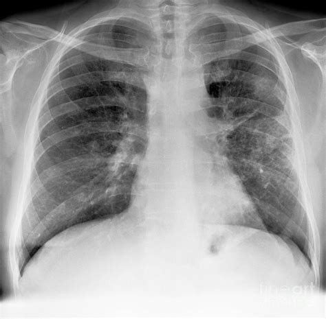 Lung Cancer, X-ray #3 Photograph by Science Photo Library - Pixels