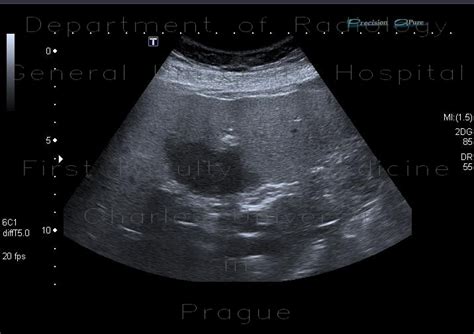 Radiology case: Focal fatty sparing