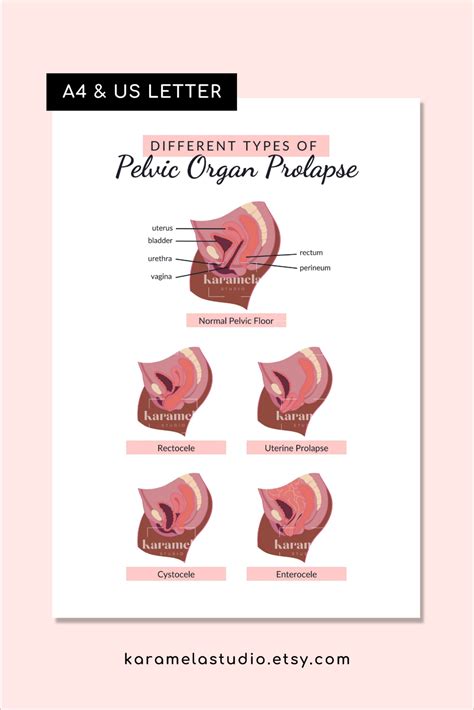 Printable Diagrams of Pelvic Organ Prolapse Pelvic Floor - Etsy UK in 2023 | Pelvic organ ...