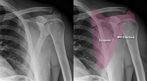 Trauma X Ray Upper Limb Gallery 2 Hand Boxer S Fracture - Gambaran