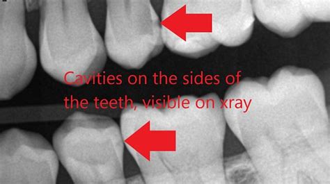 What Do Cavities Look Like On X Ray