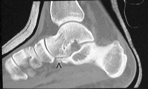 Calcaneus Fracture Swelling