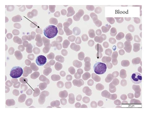 (a) Wright–Giemsa stain of peripheral blood smear shows circulating... | Download Scientific Diagram