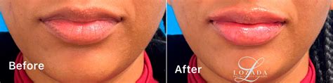 Injectable Fillers photos | Philadelphia, PA | Patient 1275