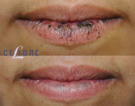 Lips Spots Removal : Dark And Sun Spots On Lips