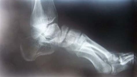 Congenital Talipes Equino Varus deformity | The Foot and Ankle Online Journal