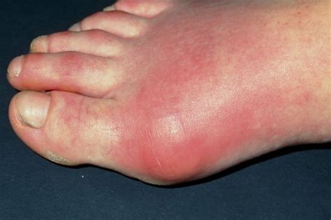 Foot pain - NHSUK