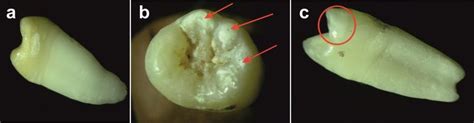 Hypoplastic teeth under study: hypoplasia across the entire tooth crown... | Download Scientific ...