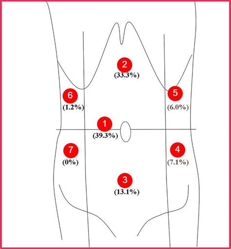 Typical & Atypical IBS Pain Locations (Diagram Included)