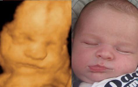 Before & After Photo Gallery – 3D and 4D Ultrasound Virginia | Baby ultrasound pictures, 3d ...