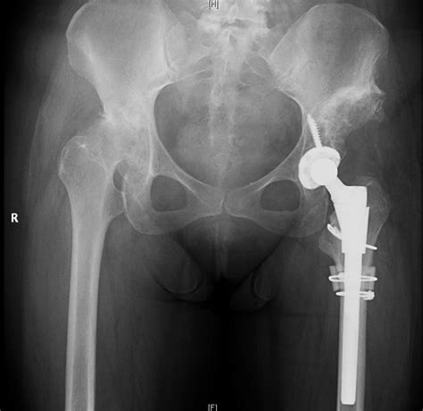 Complex THA for Severe Hip Dysplasia – Darwin Chen, MD