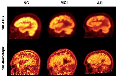 The brain’s amyloid buildup is not a powerful indicator of Alzheimer’s disease - ScienceBlog.com