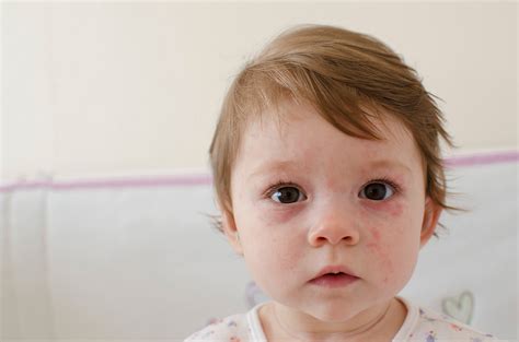 What's That Rash? 5 Common Illnesses Every Parent Needs To Know - School Mum