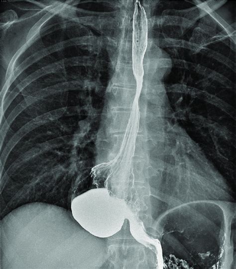 Epiphrenic Diverticula