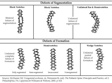 Scoliosis Progression