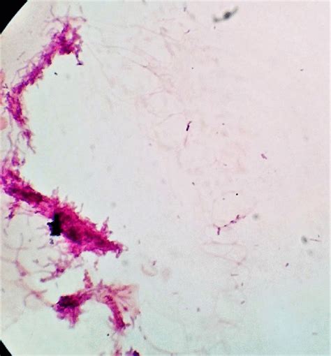 Gram stain: gram positive branching filamentous bacteria suggestive ...