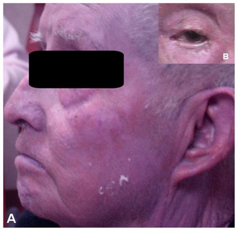 Clinical picture of the patient’s face showing the gray-bluish hue of ...