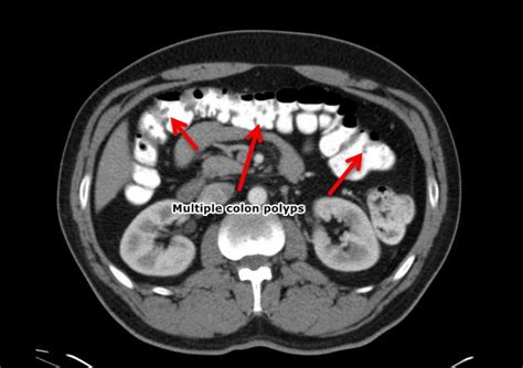 Colon polyps CT scan - wikidoc