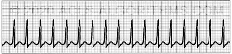 Supraventricular tachycardia (SVT) | ACLS-Algorithms.com