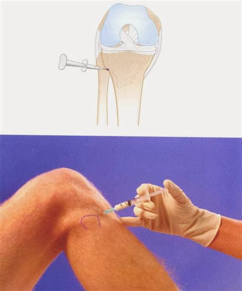 Superior Tibiofibular Joint Injection ~ Nursing